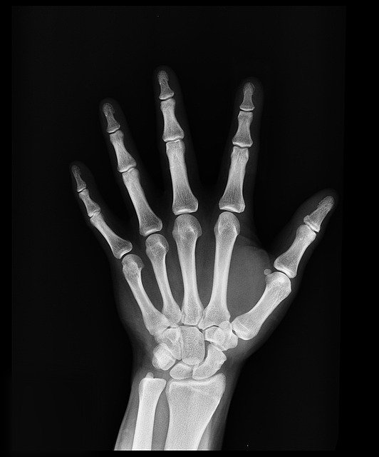 An x ray of a hand